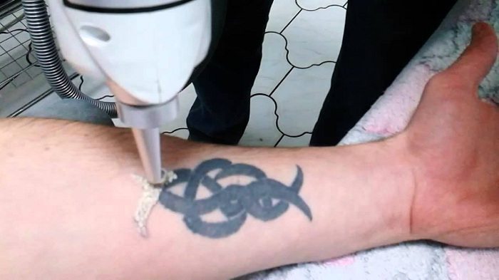 как удалить татуировку без шрама