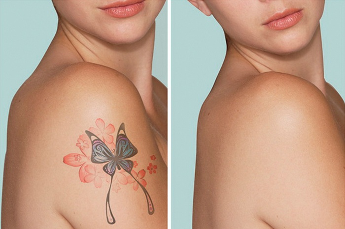 как удалить татуировки лазером