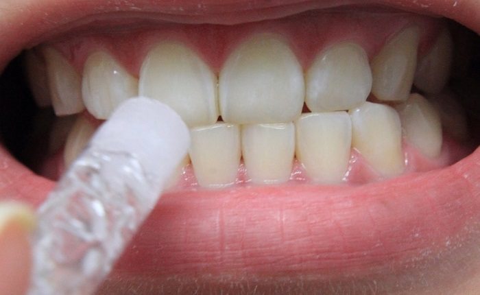 Отбеливающие гели для зубов из аптеки