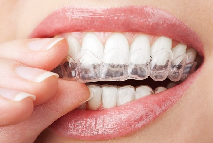 противопоказания к применению кап для отбеливания зубов