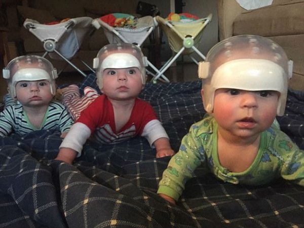 Тройняшки-«космонавты». Из-за редкого заболевания им приходится носить шлемы 